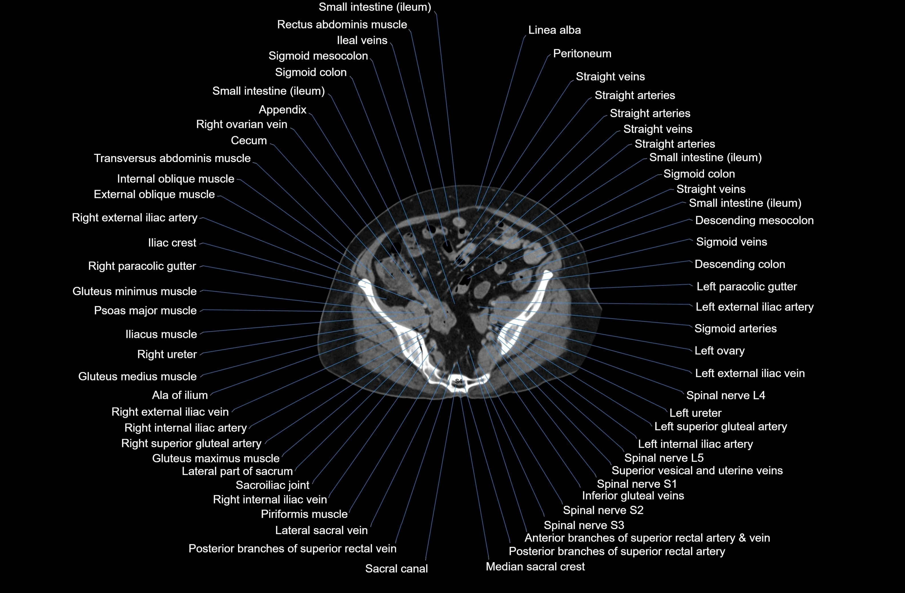 CT Abdomen axial cross sectional anatomy labelled radiology image-00074.webp
